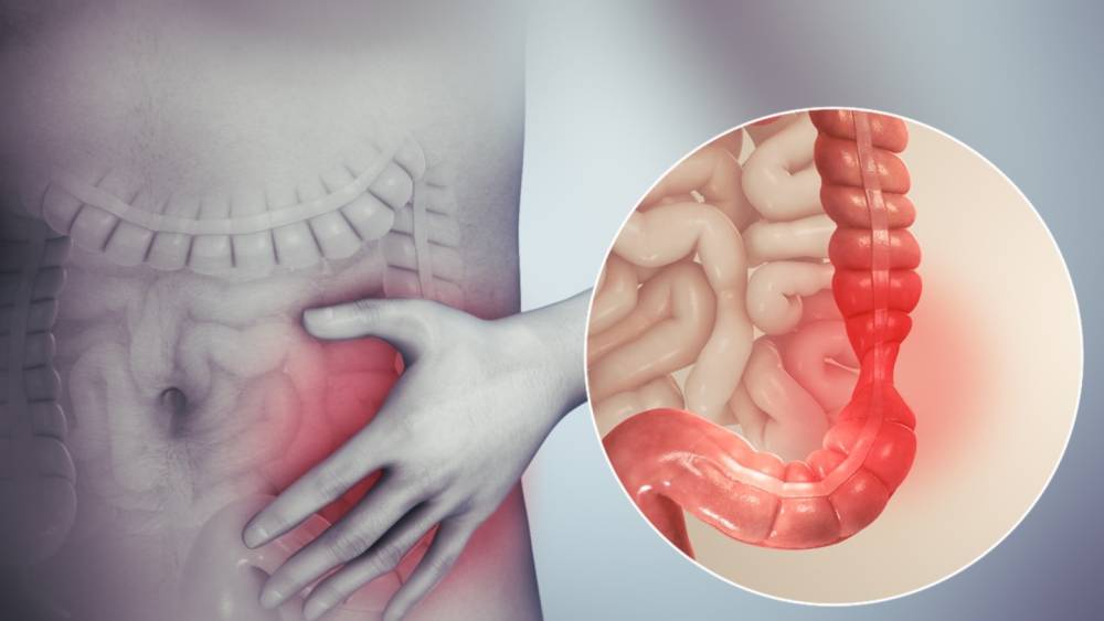 سندرم روده تحریک پذیر(IBS) چیست؟