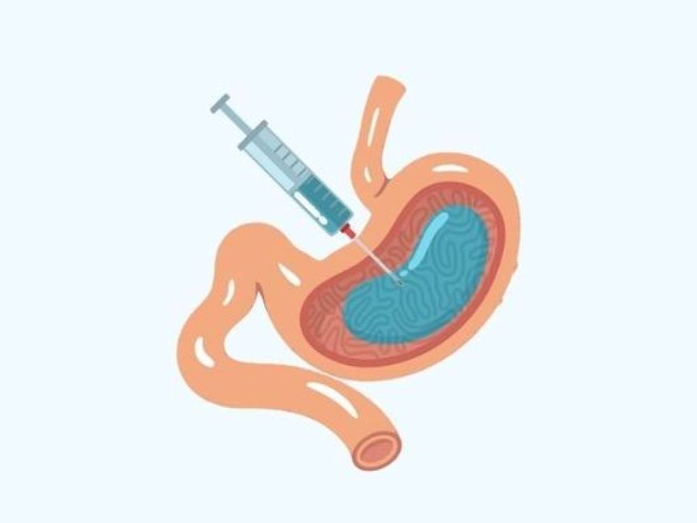 تزریق باریاتریک معده (بوتاکس معده) چیست و در لاغری چقدر موثر است؟