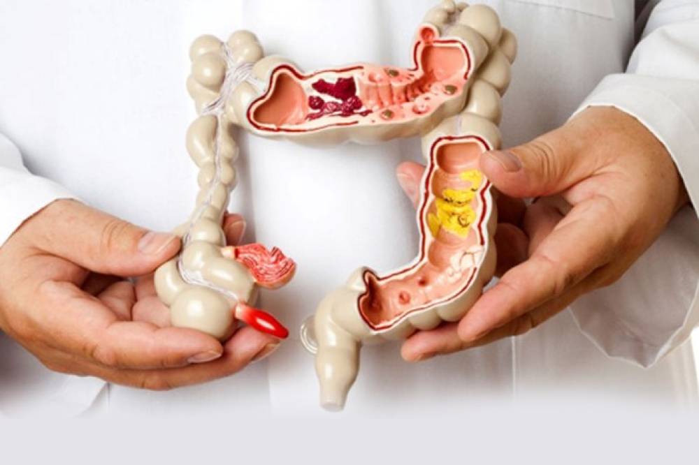 همه چیز درباره روده تحریک پذیر 