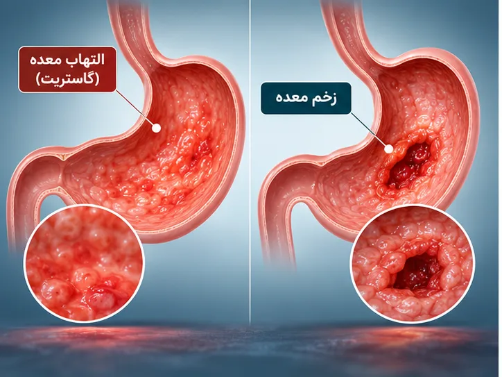 زخم معده؛ آیا افراد مبتلا می‌توانند هاربیت انجام دهند؟